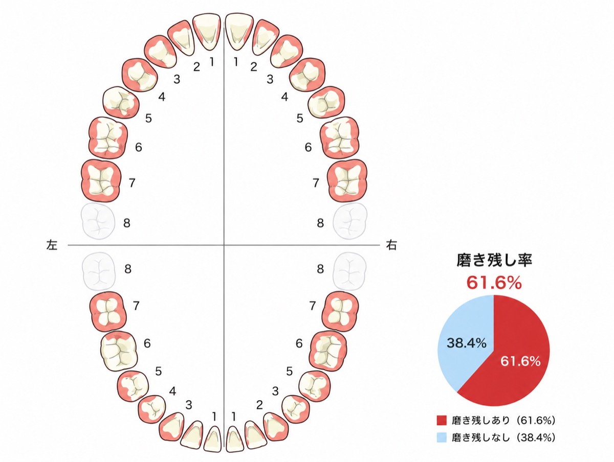 初回の磨き残し率チャート(61.6%)